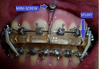 ỨNG DỤNG KỸ THUẬT 3D TRONG PHẪU THUẬT HÀM HÔ MÓM