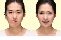 PHẪU THUẬT XƯƠNG HÀM VỚI CÔNG NGHỆ 3D