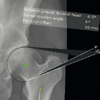 CÁC CHỨC NĂNG CƠ BẢN CỦA PHẦN MỀM MediCAD 2D – MÔ ĐUN KHỚP HÁNG (HIP)