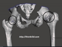 CÔNG NGHỆ 3D ĐIỀU TRỊ HOẠT TỬ CHỎM XƯƠNG ĐÙI