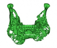PHẪU THUẬT XƯƠNG HÀM  ỨNG DỤNG CÔNG NGHỆ 3D