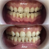 CHỈNH NHA BẰNG KHAY TRONG SUỐT – LỆCH RĂNG CỬA HÀM DƯỚI