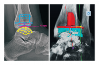 PHẦN MỀM PHẪU THUẬT CHỈNH HÌNH BÀN CHÂN 3D