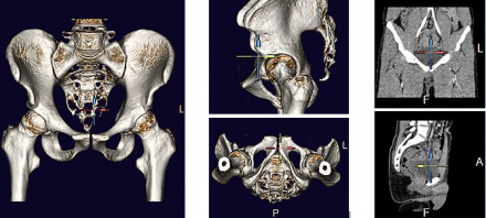 SỬ DỤNG PHẦN MỀM MediCAD ® 3D Hip TRONG PHẪU THUẬT KHỚP HÁNG, XƯƠNG HÔNG, XƯƠNG ĐÙI (Phần 1)