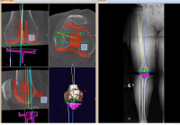 CÁC LỢI ÍCH KHI SỬ DỤNG MÔ ĐUN KNEE SPORT 3D-MEDICAD TRONG PHẪU THUẬT CHỈNH HÌNH KHỚP GỐI