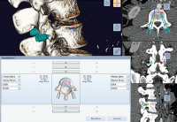 PHẦN MỀM PHẪU THUẬT CHẤN THƯƠNG CHỈNH HÌNH CỘT SỐNG 3D (Phần 2)